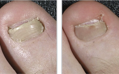 лечение грибка ногтей лазером 